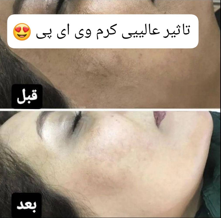 کرم وی ای پی اماراتی درجه یک سفید کننده وضدلک و ضدجوش صورت. عمده کف قیمت