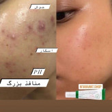 سرم ضدلکوضدجوش وروشنکننده عالی کره ای اکسیس وای