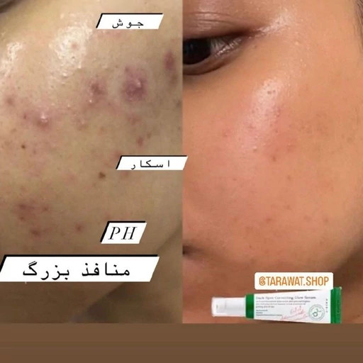 سرم ضدلکوضدجوش وروشنکننده عالی کره ای اکسیس وای