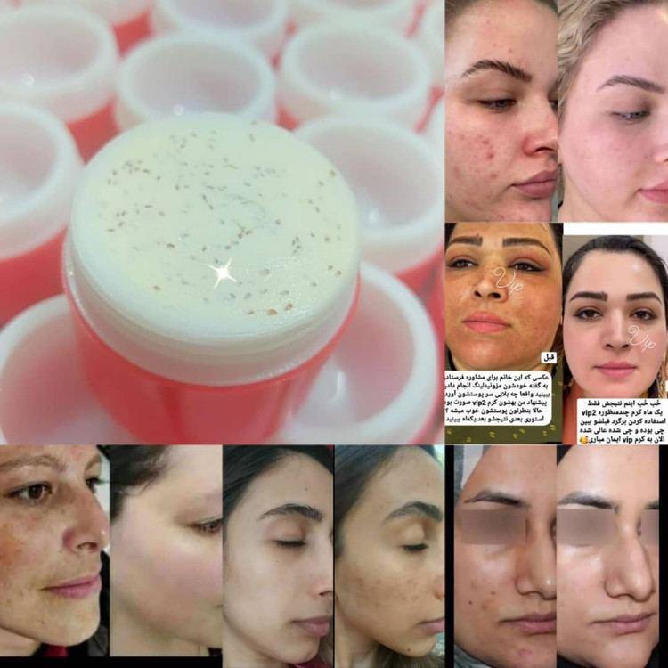 کرم وی ای پی اماراتی درجه یک سفید کننده وضدلک و ضدجوش صورت. عمده کف قیمت