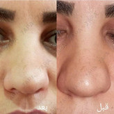 ژلکوچککننده بینی یارا کیفیت عالی