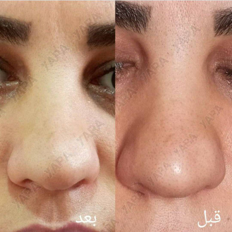 ژلکوچککننده بینی یارا کیفیت عالی