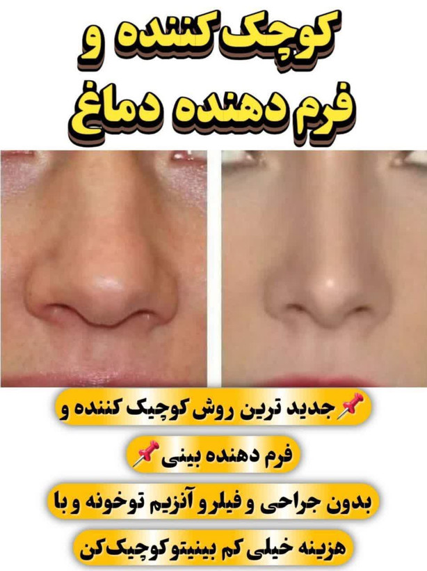 ژلکوچککننده بینی یارا کیفیت عالی