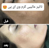 کرم وی ای پی اماراتی درجه یک سفید کننده وضدلک و ضدجوش صورت. عمده کف قیمت